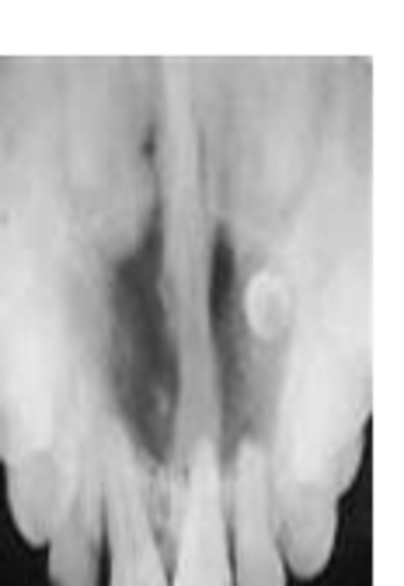 <p>well-defined unilocular radiolucency at midline hard palate</p>