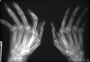 <p>Rheumatoid arthritis</p>
