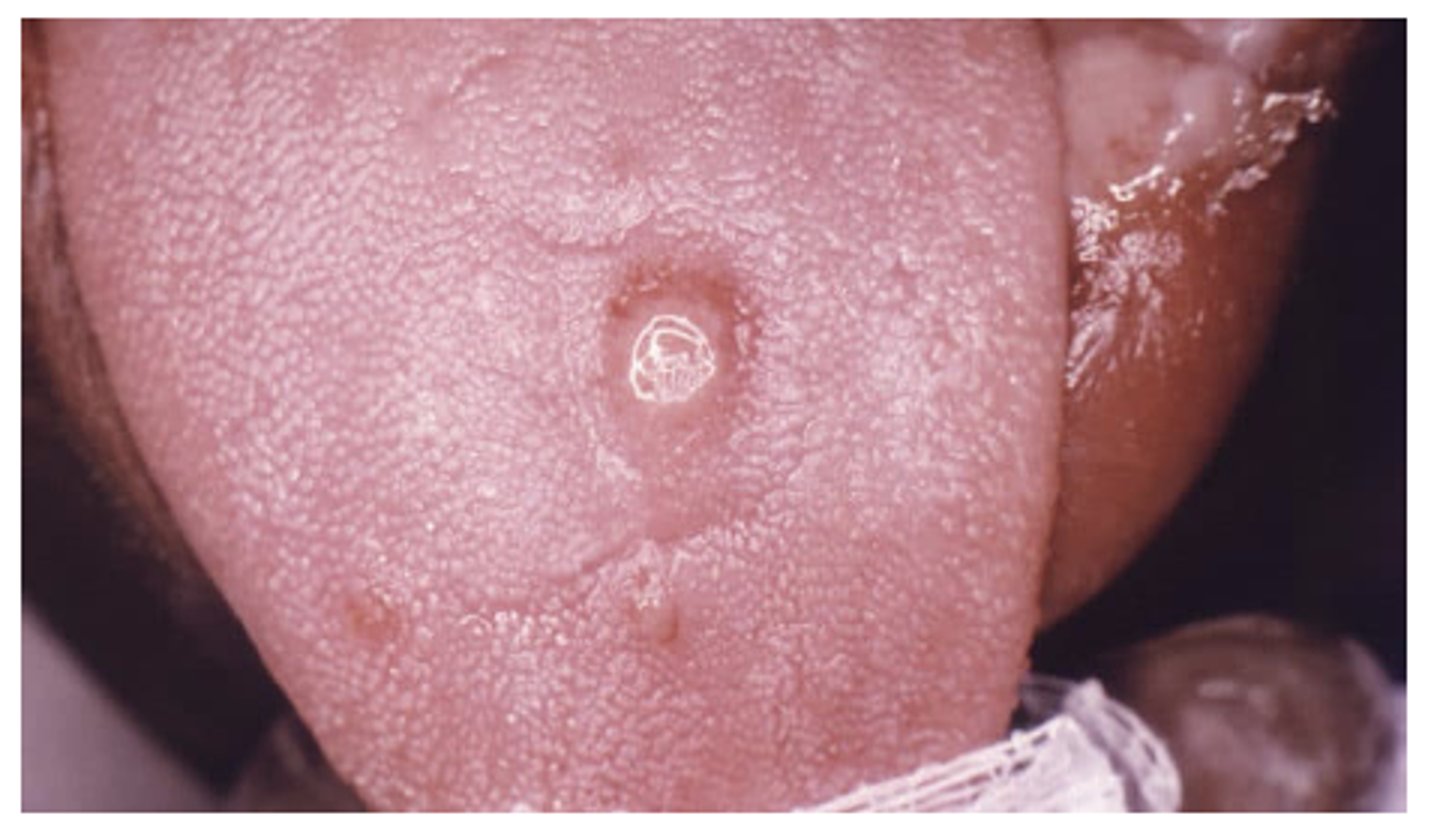<p>What is the recovery of the primary syphilis chancre like?</p>