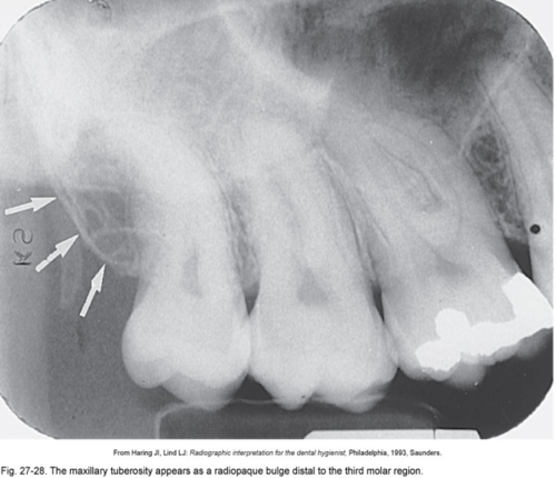 <p>Mandibular Retromolar pad</p>