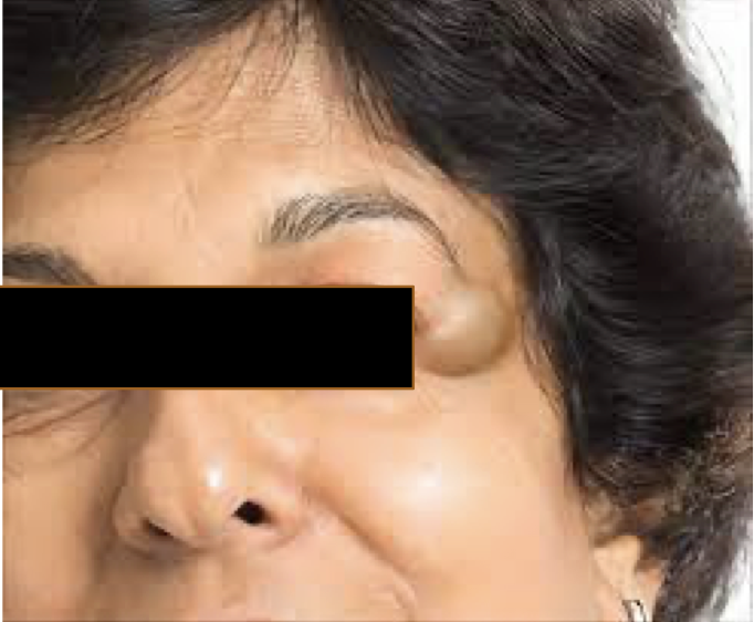 <p>A 35 year presented with cystic swelling on lateral part of forehead of 2 cm diameter. Provide DD</p>