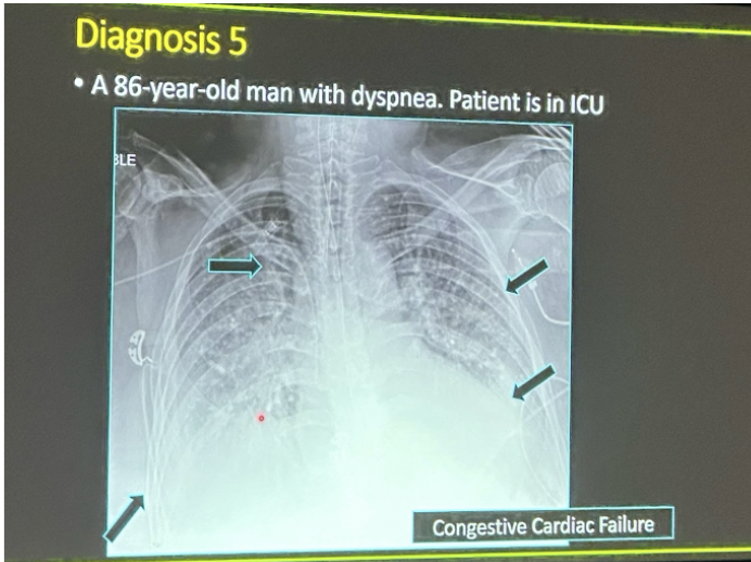 <p><em>CXR findings for acute heart failure</em></p>
