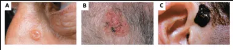Which is a melanoma