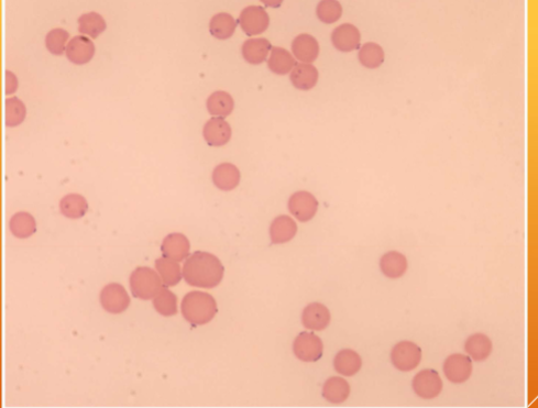 <p><span style="color: rgb(248, 246, 246);"><span>Infected blood cells are destroyed, causing progressive anemia and associated signs and symptoms (lethargy, pale MMs, death)</span></span></p>