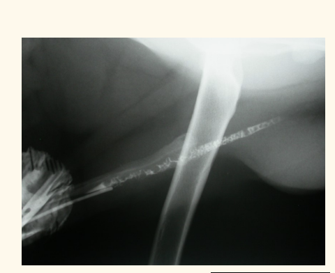 <p>– Can’t dislodge stones – Stricture has formed – Repeated obstructions</p>