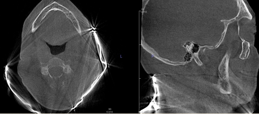 <p>It creates a streaking artifact and obscure anatomy</p>