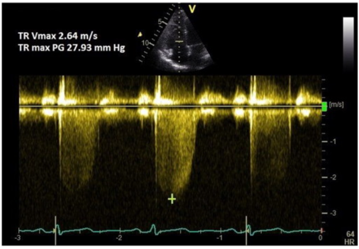 <ul><li><p>caliper to measure PV</p></li><li><p>PP gradient is calculated based on PV using bernoulli</p></li></ul><p></p>