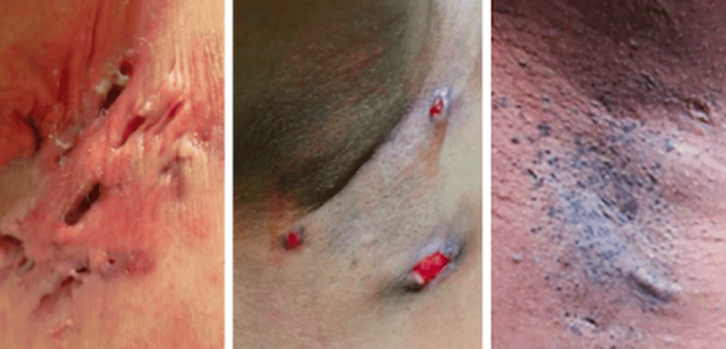 <p>Bacterial Skin Infections:</p><p>If a patient presented w the following S/S, what may you suspect they have:</p><p>- initial lesion that is very tender, red, inflammatory nodule/abscess</p><p>- open comedones or double comedones (giant dilated pores)</p><p>-<strong> tender sinus tract</strong></p><p>-<strong> smelly pus drains from the opening of the abscesses &amp; sinus tract</strong></p><p>- <strong>hypertrophied, keloided scars</strong> from old lesions</p>
