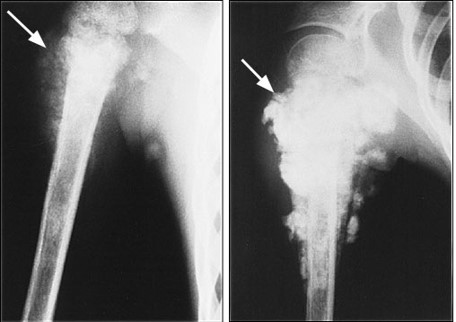 <p>Osteosarcoma</p>