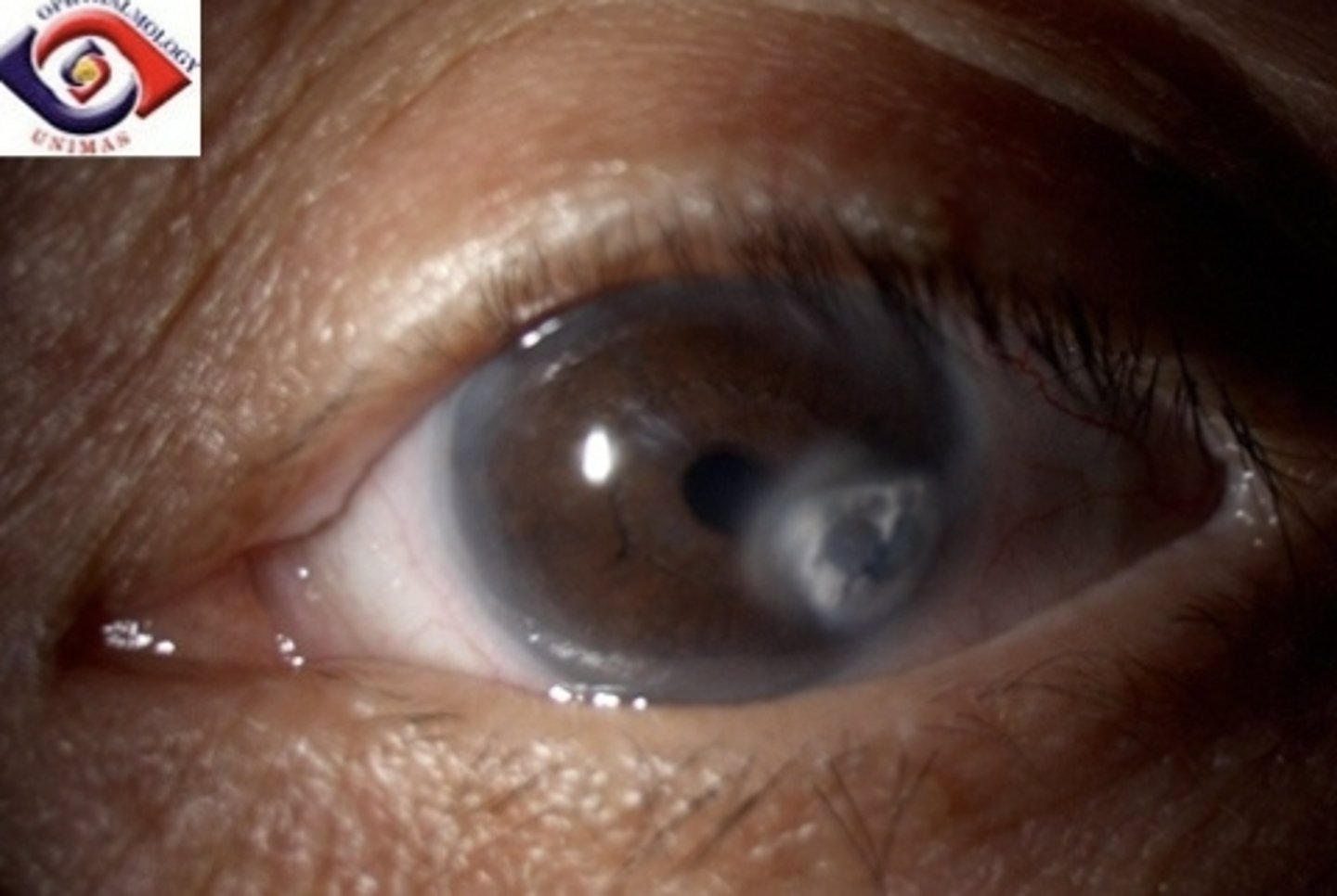 <p><u>Etio</u>: infected open sore or wound (<strong><mark data-color="#fffe00" style="background-color: #fffe00; color: inherit">Pseudomonas aeruginosa</mark>, M. Catarrhalis, and S. Aureus)</strong></p><p><u>Risk factors:</u> <strong>wears contacts overnight</strong>, corneal trauma</p><p><u>S&amp;S</u>: <strong>acute painful, red eye w/ corneal abnormality: circus-corneal injection, hazy cornea</strong>, photophobia, reduced vision, purulent or watery tearing</p><p><u>Testing</u>: fluorescein stain + uptake <strong>(pooling)</strong></p><p><u>Tx</u>: <strong><u>1st line:</u></strong> <strong>fluoroquinolones</strong> (levofloxacin 0.5% opthalmic solution), emergent optho referral, no contacts, DO NOT patch eye</p>