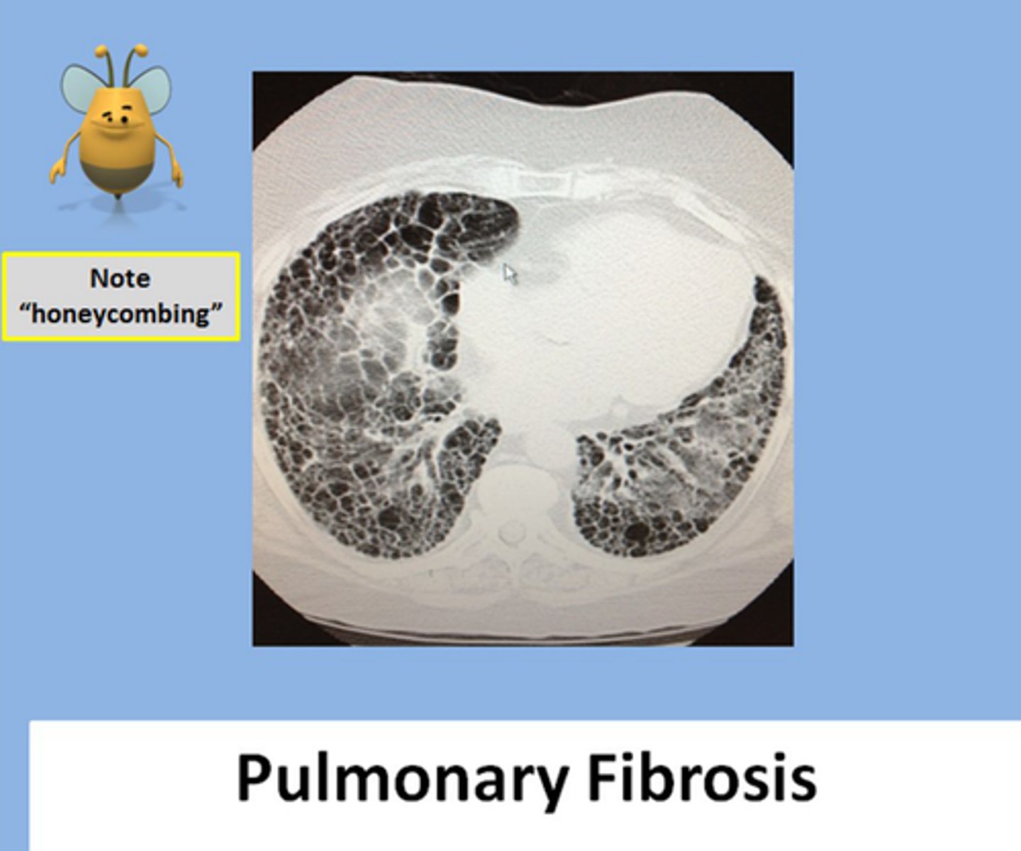 <p>Lung biopsy (via VATS or bronchoscopy); CT (shows fibrosis &amp; "honeycombing" blebs)</p>