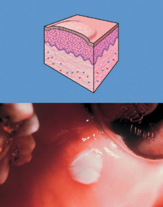 <p>(> 1 cm in diameter)</p>