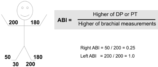 <p>Considering ABI results, which side is abnormal? </p>