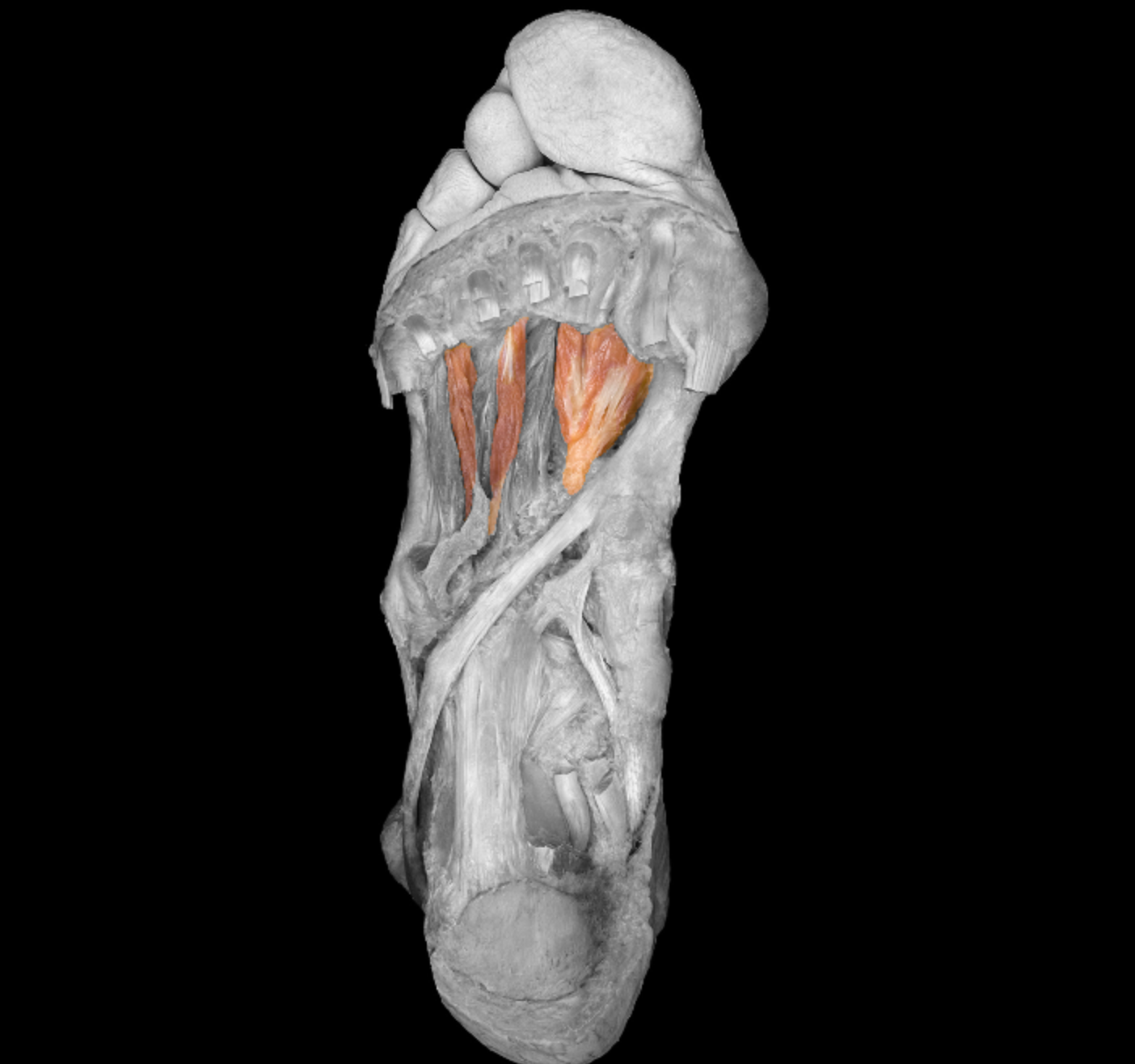 <p>origin: metatarsals </p><p></p><p>insertion: proximal phalanges </p><p></p><p>action: abduct, extend, flex toes</p><p></p><p>innervation: lateral plantar nerve </p>