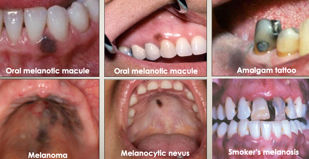 <p>What should be included in the differential diagnoses for brown/black pigmentations?</p>