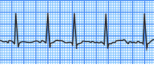 <p><u>In Atrial Fibrillation</u></p><ul><li><p>__ atrial activity, with coordinated __ contraction</p></li><li><p>No _-wave before QRS</p></li><li><p>QRS is __, ST is __, T-wave is __</p></li></ul><p></p>