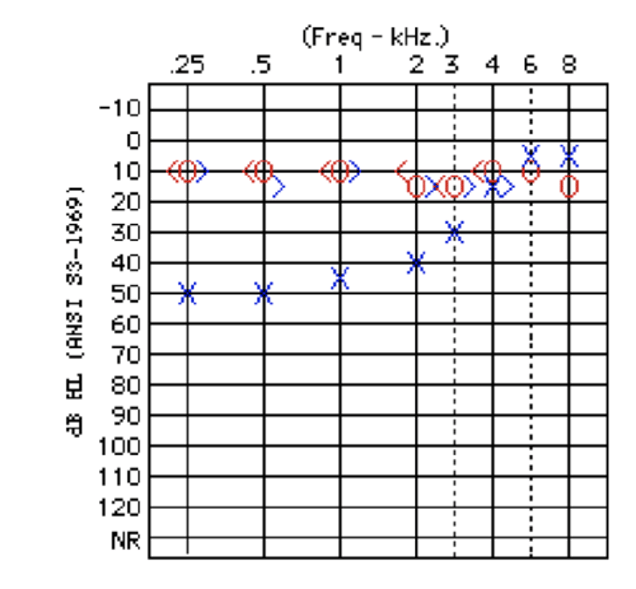 <p>- since the inter aural attenuation value for bone conduction is 0 dB, cross hearing is always a threat when testing by bone conduction.</p><p>- in other words, it doesn’t matter where we place the bone conduction oscillator, the cochlea with the better hearing will always respond first.</p><p>- when there is an air/bone gap of greater than 10 dB in the test ear then cross hearing is a threat to the accuracy of our results.</p><p>AC(TE) - BC(TE) &gt; 10 then cross hearing is a problem (POOR EAR)</p>