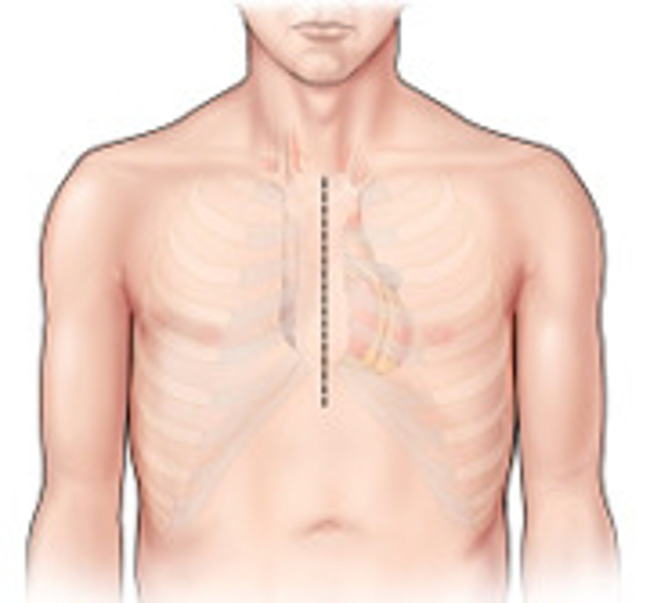 <p>vertical inline incision made along the sternum</p><p>Sternum divided with saw to provide access to the heart and lungs</p><p><strong>Heart transplant, corrective surgery for CHD, CABG</strong></p>
