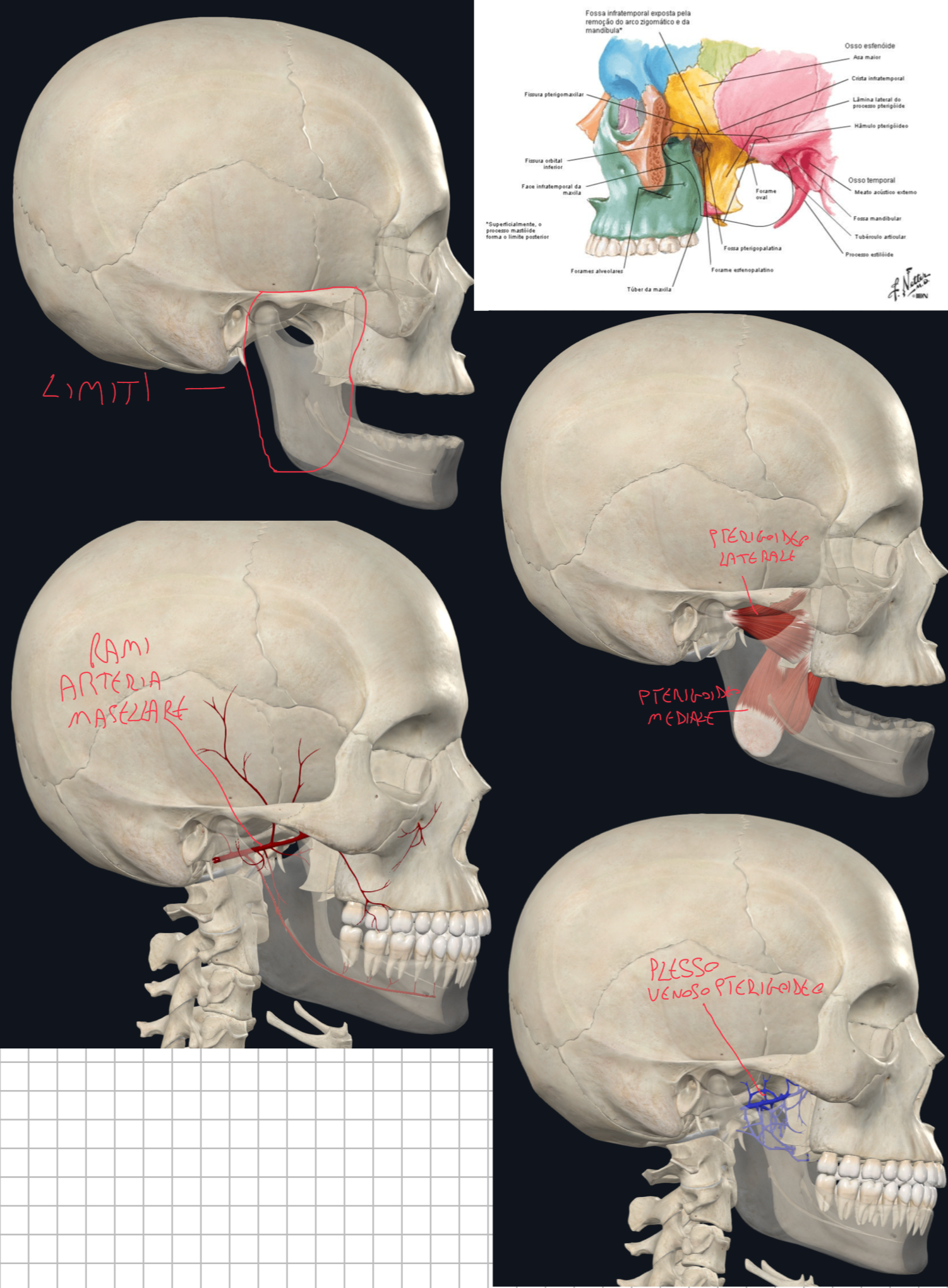 <p>FOSSA INFRATEMPORALE:</p><ul><li><p>Limiti:</p><ul><li><p>Superiormente → Cresta e Superficie Infratemporale grande ala Sfenoide, e parte dell’osso temporale</p></li><li><p>Lateralmente → Ramo della Mandibola</p></li><li><p>Medialmente → Lamina Laterale del Processo Pterigoideo dello Sfenoide</p></li><li><p>Posteriormente → Processo Stiloideo, Regione Mastoidea e Fossa mandibolare dell’Osso Temporale</p></li><li><p>Anteriormente → Tuberosità Mascellare</p></li></ul></li><li><p>Contenuto:</p><ul><li><p>Muscolo Pterigoideo Laterale → il capo superiore origina dalla cresta infratemporale dello Sfenoide, mentre quello inferiore dalla faccia laterale della lamina laterale del processo pterigoideo dello Sfenoide → si inseriscono sul collo della mandibola (fossa pterigoidea) → servono per abbassamento mandibola, protrusione e lateralità</p></li></ul><ul><li><p>Muscolo Pterigoideo Mediale → il capo profondo origina dalla faccia mediale della lamina laterale del processo pterigoideo dello Sfenoide, mentre quello superficiale dalla tuberosità mascellare → si inseriscono sulla faccia mediale del ramo mandibolare all’angolo della mandibola → servono per elevazione e protrusione mandibola.</p></li><li><p>Rami Arteria Mascellare (parte mandibolare e pterigoidea)</p></li><li><p>Plesso Venoso Pterigoideo → è un plesso senza valvole, quindi il sangue scorre a seconda del gradiente pressorio (la contrazione dei muscoli pterigoidei favorisce il drenaggio) → può drenare verso le vene superficiali (mascellari → retromandibolare → giugulare tramite divisioni) oppure verso vene del neurocranio (seno cavernoso → vena oftalmica superiore o inferiore, collegamento possibile grazie a vene emissarie) → avendo questa bidirezionalità, trombi o infezioni possono passare al neurocranio facilmente.</p></li><li><p>Nervo Mandibolare (terza branca del trigemino)</p></li></ul></li></ul><p></p>