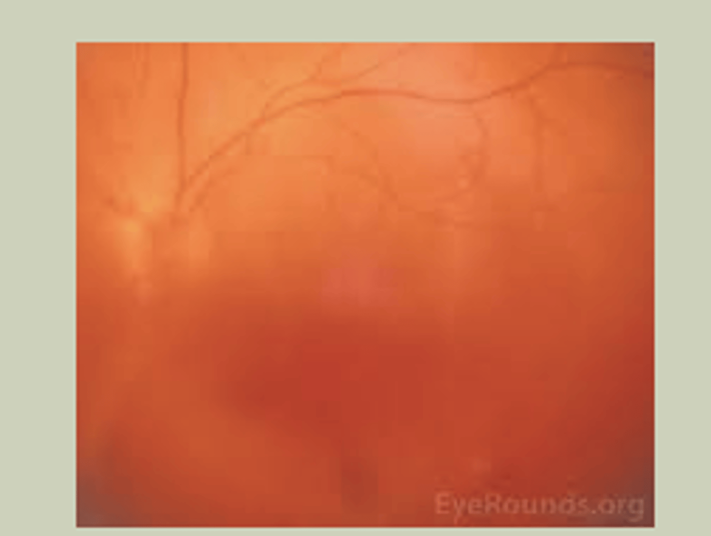 <p>-Sudden onset, painless blurred vision in one eye</p><p>-Poor control of DM</p><p>-Will not be able to evaluate fundus with DO</p><p>-TX: URGENT referral to ECP STAT referral to retinal specialist</p>