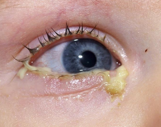 <p><strong><mark data-color="yellow" style="background-color: yellow; color: inherit"><u>H. influenza - bacteria</u></mark></strong></p><ul><li><p>similiar signs and symptoms as previous conjunctivitis</p><ul><li><p>papillary</p></li></ul></li></ul><p></p>