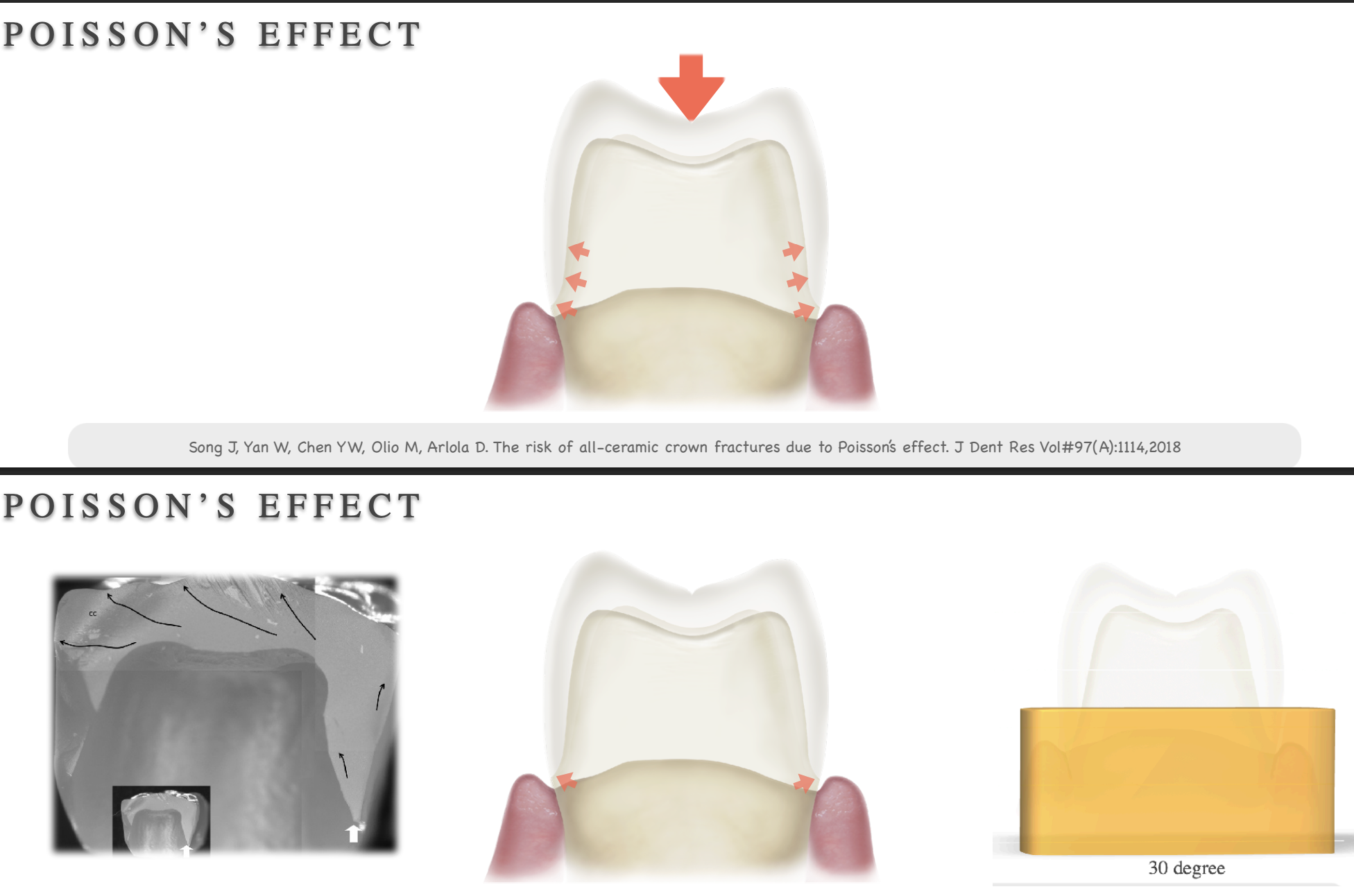 <p>when you reduce enamel → your prep is getting more tapered → more dentin exposed → dentin is more flexible than enamel → occlusal force under no enamel and hard material over dentin → force will go to cervical area bc this is the weak point → cervical crack propagation </p>