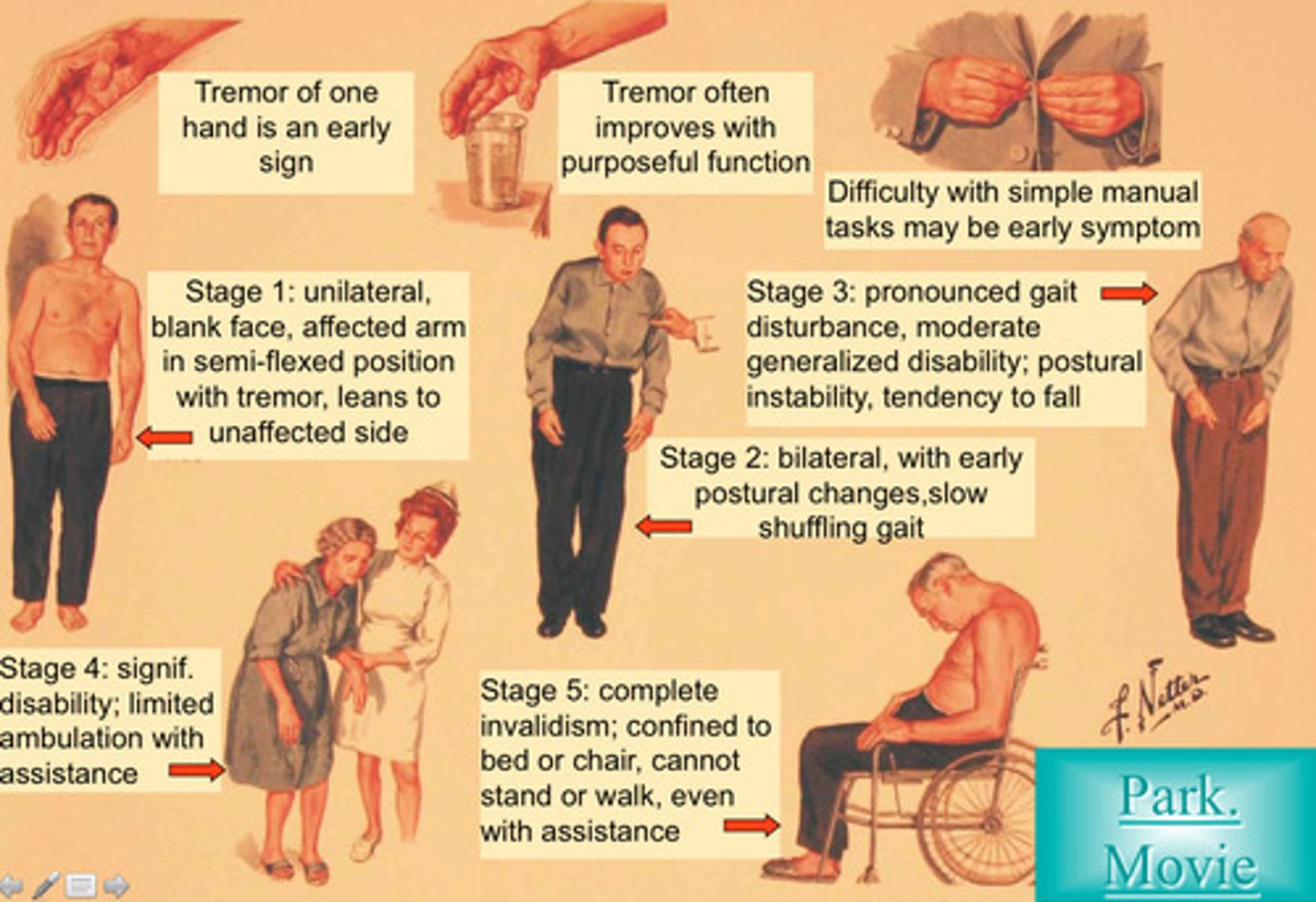 <p>A slow, progressive neurological disease caused by degeneration of dopaminergic neurons in the substantia nigra - results in depletion of dopamine in the striatum</p>