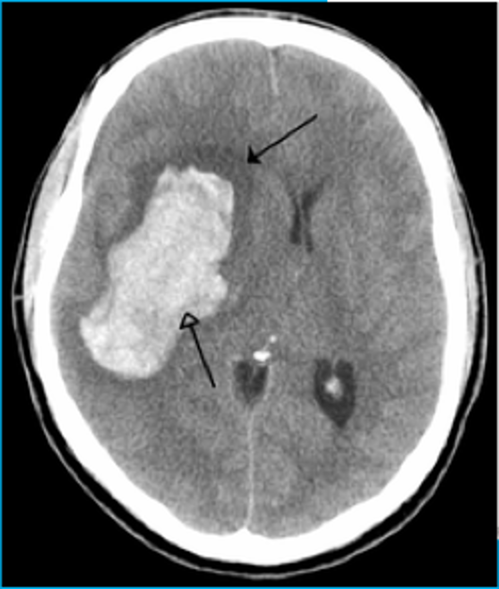 <p>a hematoma located inside the brain tissue</p><p>- ventricles</p><p>- can be chronic</p><p>- craniotomy can remove</p>