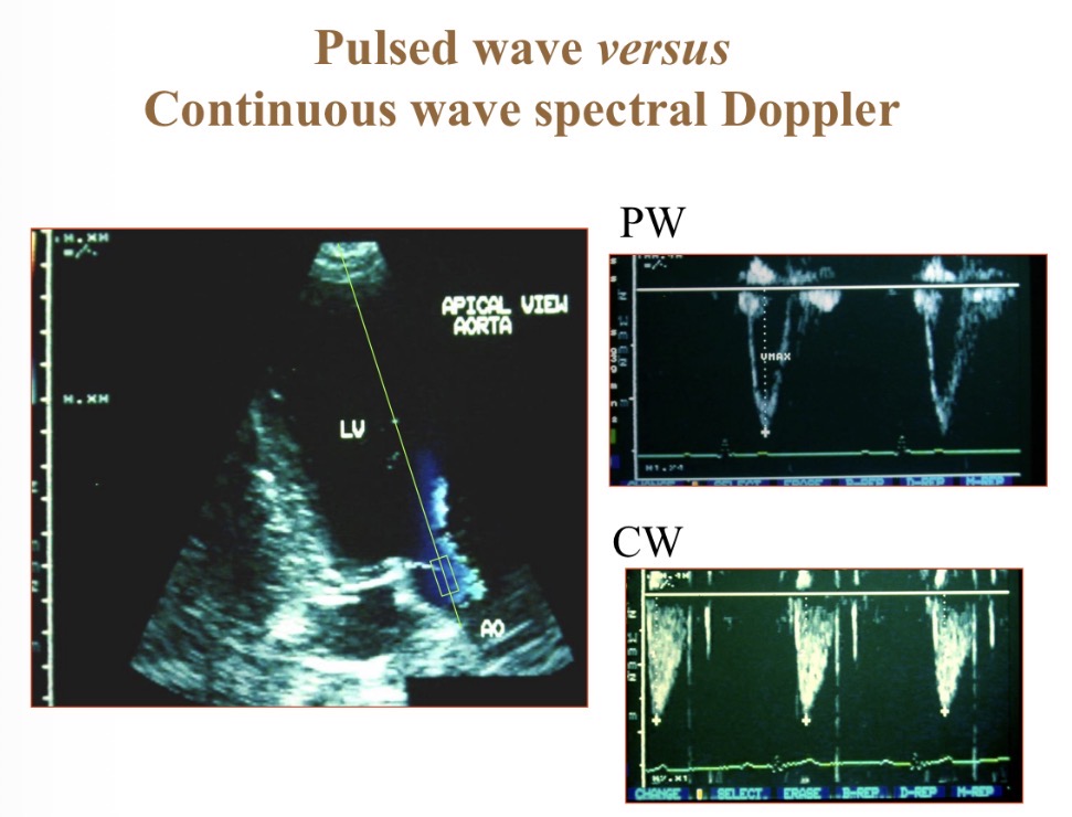 <p>Pulsed wave Doppler </p>