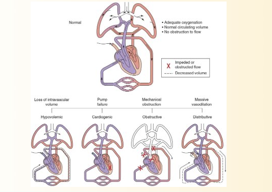 <ol><li><p>Hypovolemic = loss of intravascular volume</p></li><li><p>Cardiogenic = pump fialure</p></li><li><p>Obstructive shock = mechanical obstrucitn of blood flow through central circulation</p></li><li><p>Distributive shock = massive vasodilation</p></li></ol><p>BE FAMILAR WITH EACH, LOOK AT PICTURE</p>