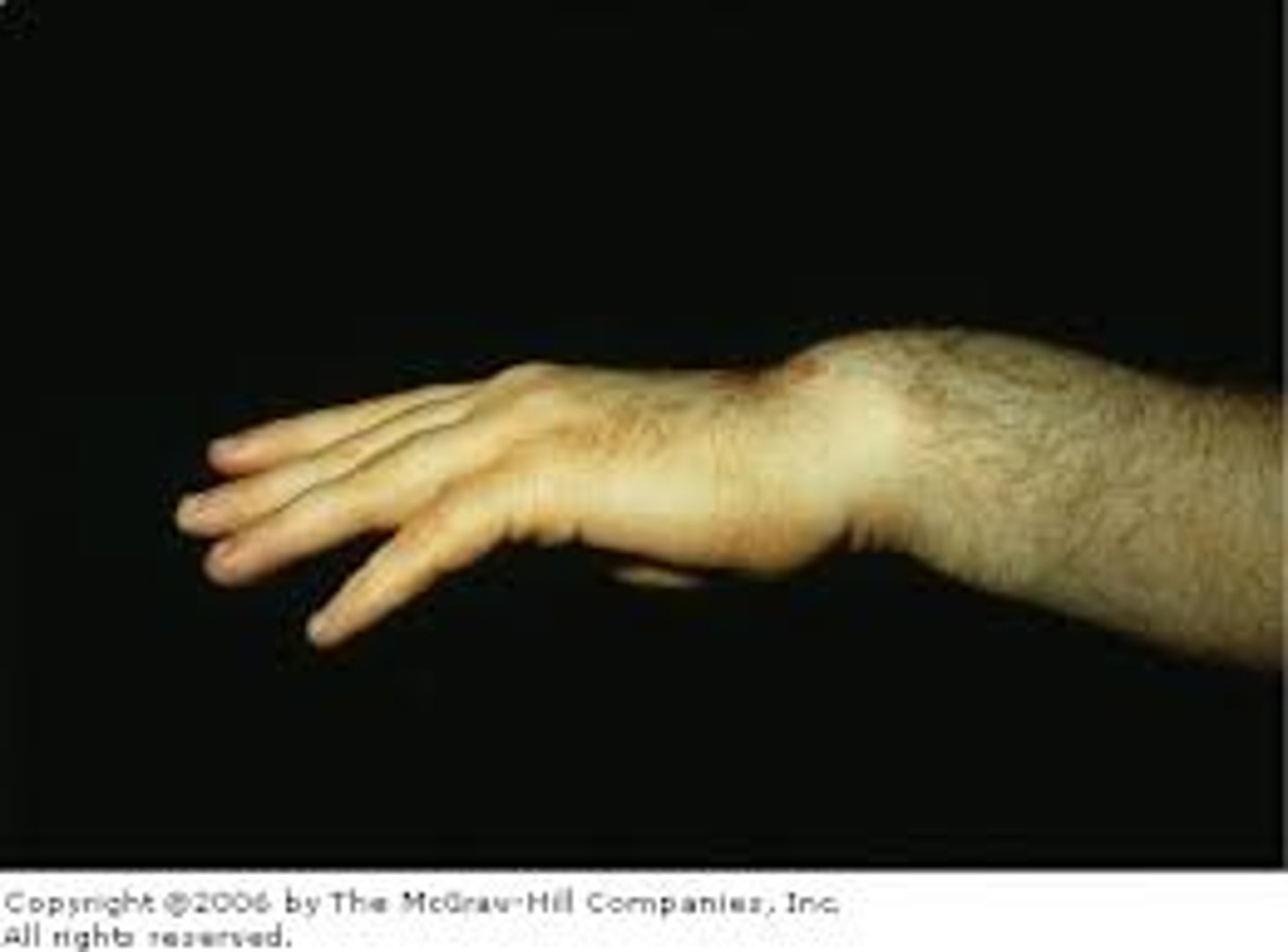 <p>distal fragment of radius dislocates in a volar direction result in garden spade deformity</p>