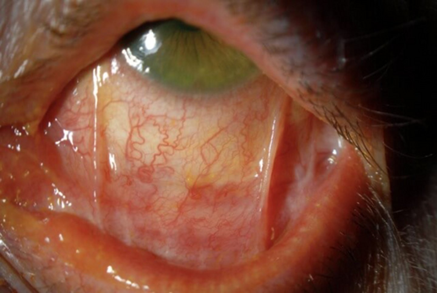 <p>A patient with oral lesions develops progressive eye scarring that may lead to blindness. What is the MOST likely diagnosis?</p>