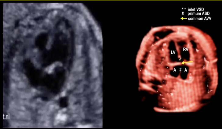<p>the most common cardiac defect seen w/trisomy 21</p><p>a) patent ductus arteriosus</p><p>b) ventricular septal defect</p><p>c) AV canal defect or AVSD</p><p>d) atrial septal defect</p>