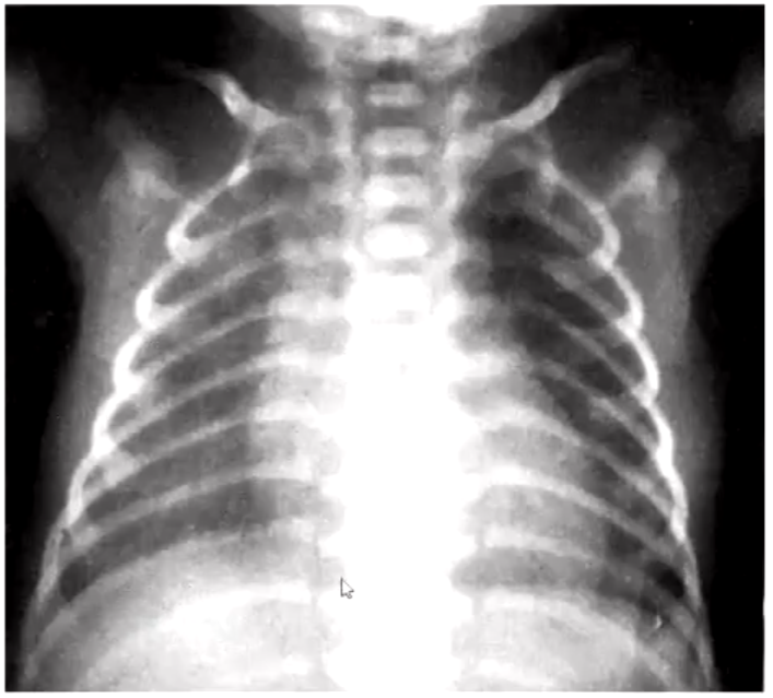 Overexposed and clavicles are too high -covers the apices