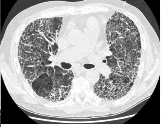 <p>benign or malignant?</p>