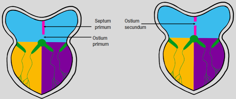 <ul><li><p>septum primum grows from the top to ostium primum</p></li><li><p>apoptosis happens to form ostium secundum→ forms a gap</p></li><li><p>septum secundum’ blocks ostium secundum→ still a small space (foramen ovale) for blood to travel through</p><ul><li><p>when baby is born, gap closes leaving fossa ovalis</p></li></ul></li></ul><p></p>