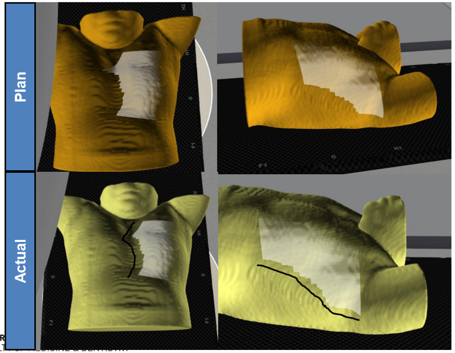 <p>assume the patient’s lateral is correct, what is the positioning error? what impact does it have on the lung volume treated?</p>