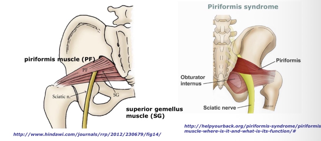 <p>m. piriformis tunelinis sindromas</p>