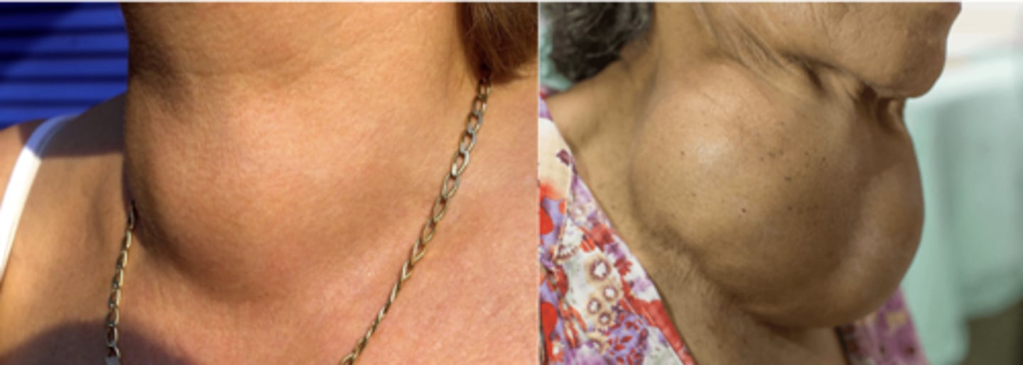 <p>Excessive Thyroid Function or Lack of Iodine</p><p>Treatment: depends on the underlying cause</p><p>levothyroxine if caused by underactive thyroid</p><p>methimazole or propylthiouracil (PTU) if overactive thyroid</p><p>Corticosteroid medication if goiter is caused by inflammation</p>