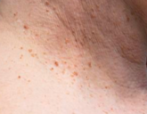 <p>EXPECTED AGE-RELATED CHANGES</p><p>Are small, brown or flesh- colored projections of skin and most often observed on the necks</p>