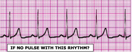 <p>What is happening when there is organized electrical activity on the monitor, but no mechanical activity?</p>