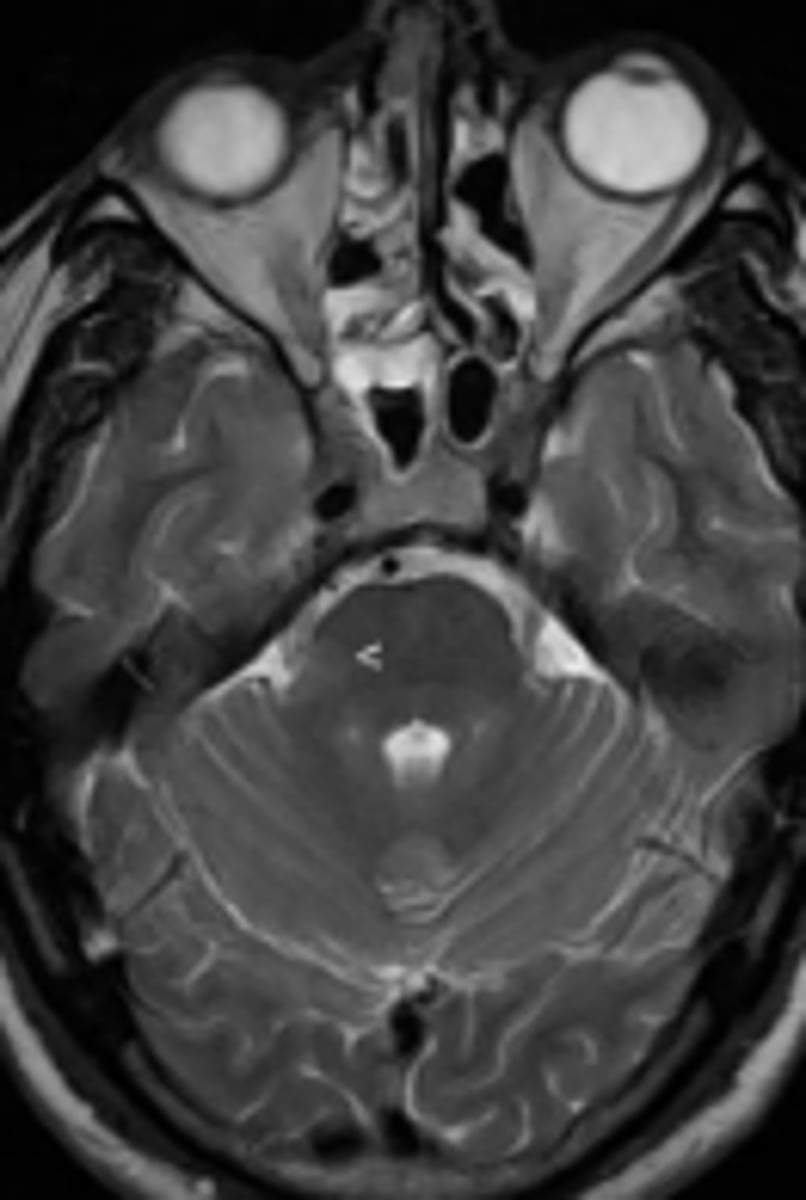 <p>MRI sequence that highlights locations of fat using gadolinium for contrast.</p>
