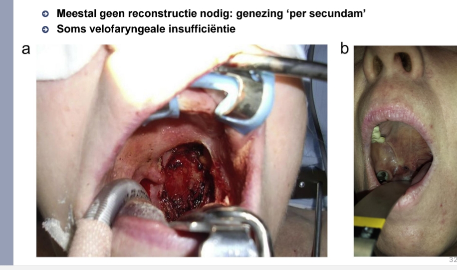 <p>Meestal geen reconstructie nodig: genezing ‘per secundam’<br>Soms velofaryngeale insufficiëntie</p>