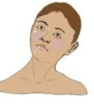 <p><strong>What are sx of Torticollis?</strong></p>