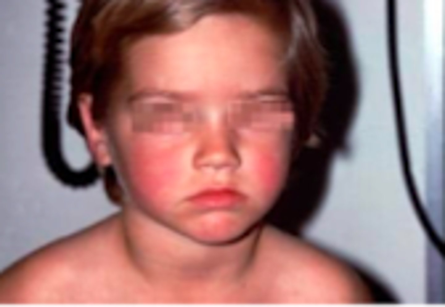 <p>Exanthems:</p><p>Objective:</p><p>Classic slapped-cheek appearance</p><p>- Bright red, raised erythema appears abruptly over cheeks; marked by nasal, perioral, periorbital sparing</p><p>- Appears like a sunburn, edematous sometimes; fades after 2-4 days</p><p>Next phase is 1-4 days later and is characterized by an erythematous maculopapular rash on proximal extremities (usually arms/extensor surfaces) and trunk, which fades into classic lacelike reticular pattern</p><p>Palms and soles usually spared</p>