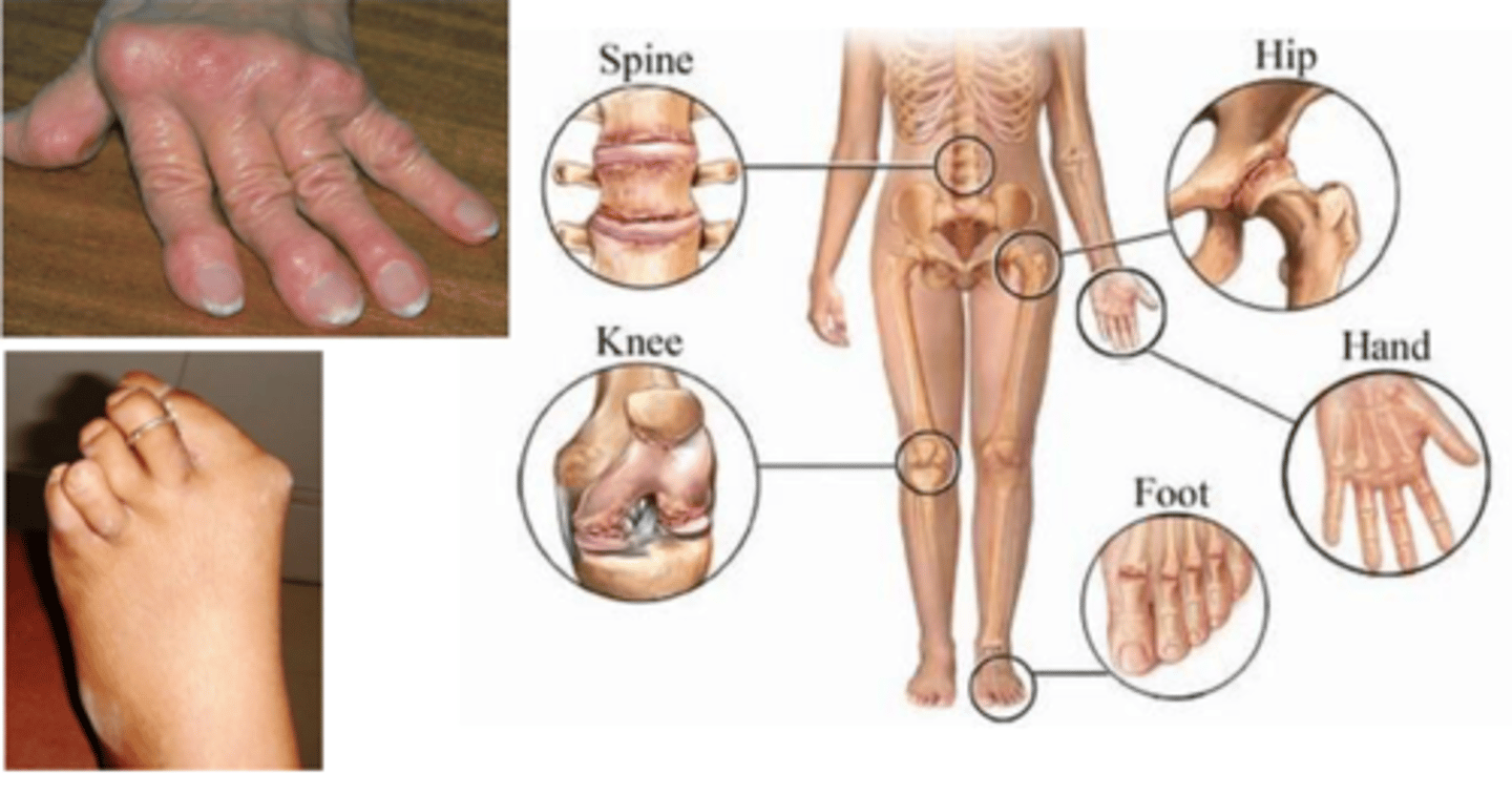 <p>1. Symmetrical<br>2. Deforming <br>3. Polyarthropathy <br>4. Erosion on x-ray <br>5. 80% are RF +ve</p>