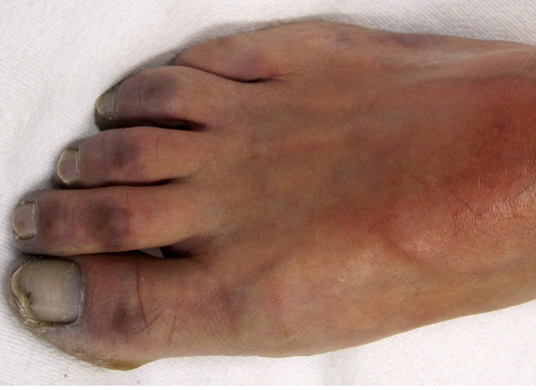 <p>May be a local problem resulting from vasoconstriction</p><p>Blueish discoloration of skin or extremities due to vasoconstriction (poor blood flow/oxygenation)</p>