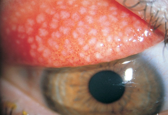 <ul><li><p><span style="color: red"><strong>Conjunctival reaction due to mechanical action</strong></span> - CL / Ocular Prosthesis</p></li><li><p>Reaction is <span style="color: blue"><u>exacerbated by</u><strong><u> protein deposits</u></strong><u> on the surface of a CL / Prosthesis</u></span></p></li><li><p><span style="color: green"><strong>Mucus discharge</strong> and papillae under upper lid</span></p></li></ul><p></p>