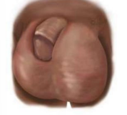 <p><strong>Scrotal Edema</strong></p><p>-Usually ______ and self-limiting, tenderness</p><p>-Inspection → enlarged _______ that may be erythematous</p><p>-Palpation → ____ with pitting, difficulty palpating ______ content </p>