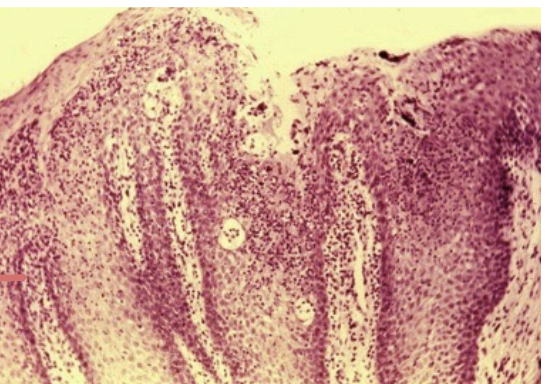 <p>Under keratinized and loss of papilla </p>